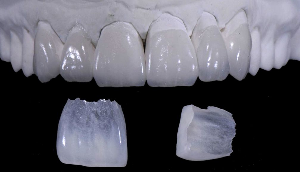 No-Prep Veneers